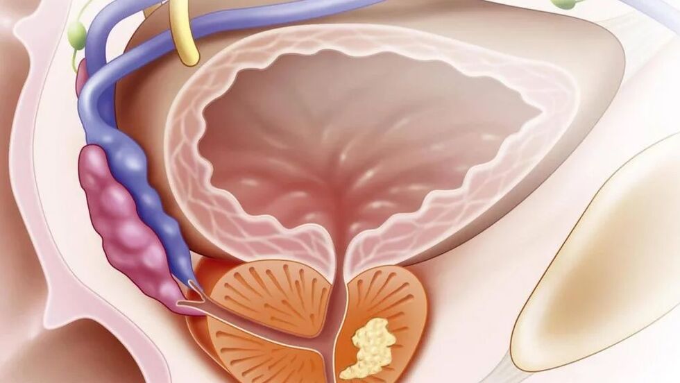 Non -bacterial chronic prostatitis