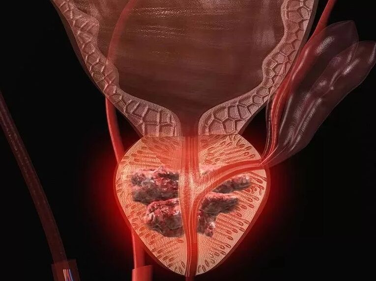 Prostatitis in men