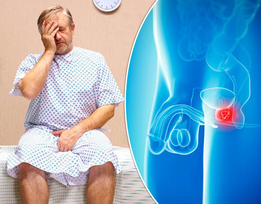 A man with prostatitis undergoes diagnosis of the disease