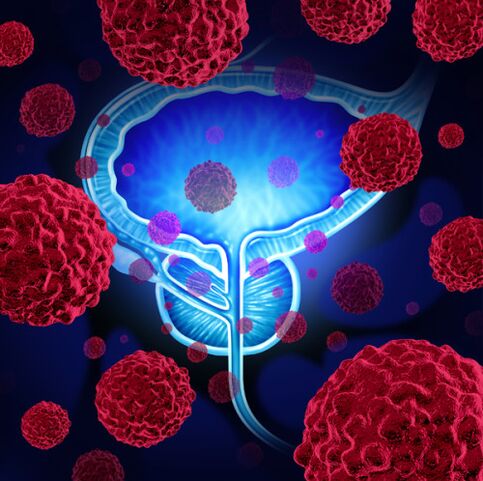 The activity of pathogenic microorganisms is the reason for the development of prostatitis