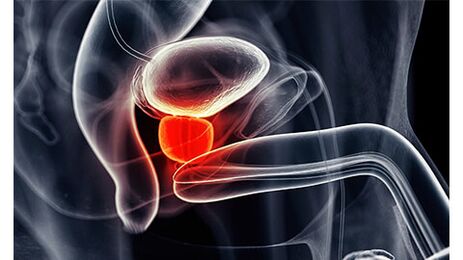 prostate inflammation